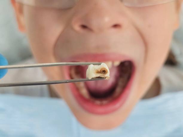 Best Dentist for Tooth Abscess  in Charlotte, TX